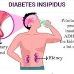 Diabetes Insipidus প্রতিদিন ১০০ গ্লাস জল না খেলেই মারা যাবেন তিনি