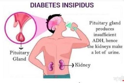 Diabetes Insipidus প্রতিদিন ১০০ গ্লাস জল না খেলেই মারা যাবেন তিনি