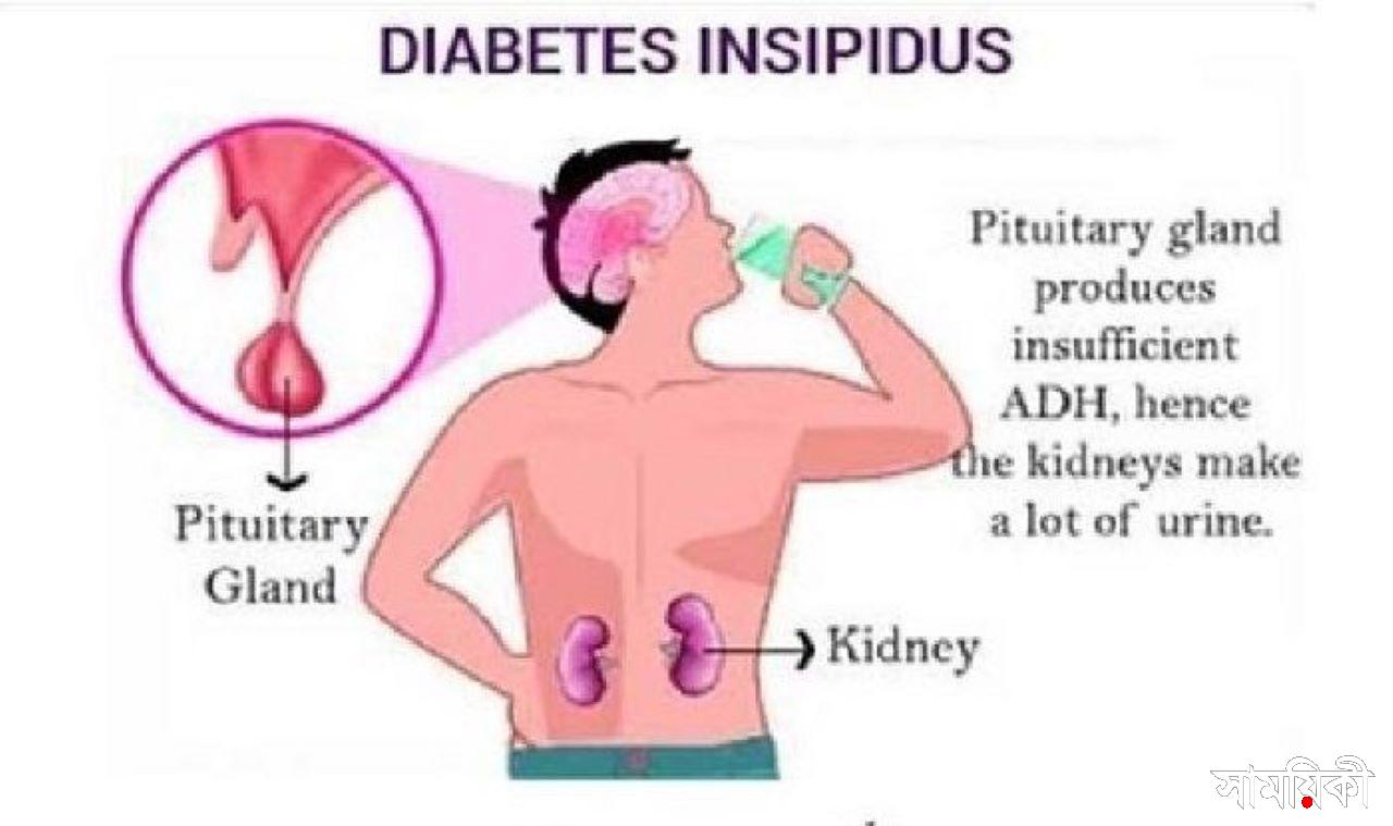Diabetes Insipidus প্রতিদিন ১০০ গ্লাস জল না খেলেই মারা যাবেন তিনি